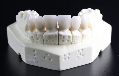 השתלת שיניים למחוסרי עצם: כל הדרכים והאלטרנטיבות העדכניות בעולם הרפואה